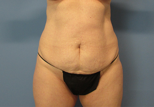 Tummy Tuck Before and After | SGK Plastic Surgery