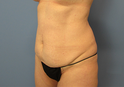 Tummy Tuck Before and After | SGK Plastic Surgery