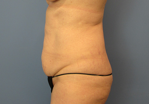 Tummy Tuck Before and After | SGK Plastic Surgery