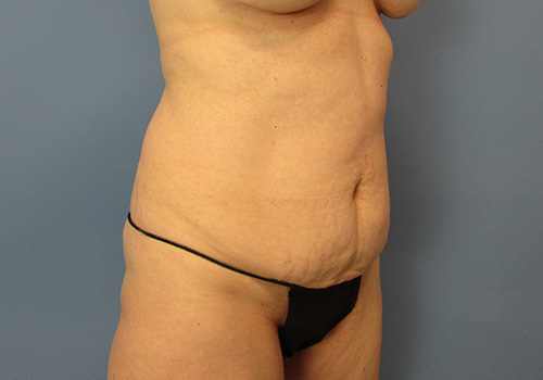 Tummy Tuck Before and After | SGK Plastic Surgery