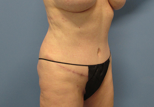 Tummy Tuck Before and After | SGK Plastic Surgery