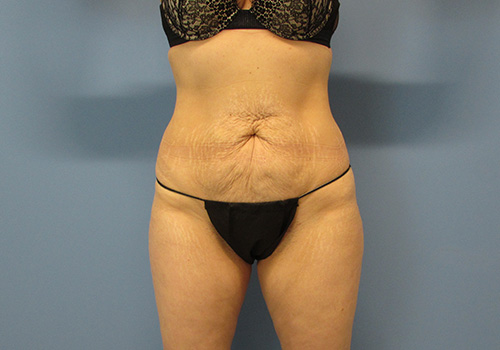 Tummy Tuck Before and After | SGK Plastic Surgery