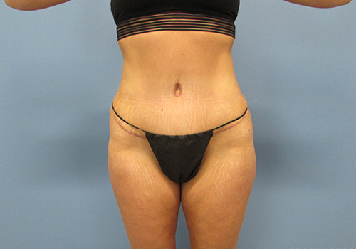 Tummy Tuck Before and After | SGK Plastic Surgery