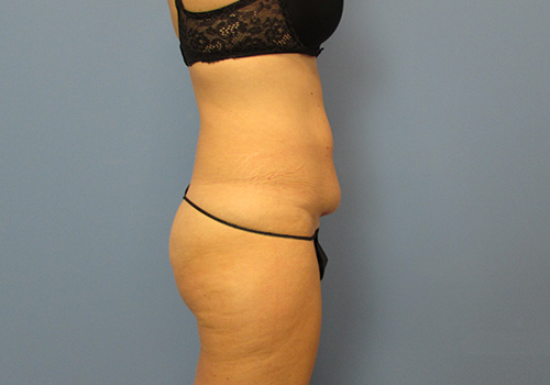 Tummy Tuck Before and After | SGK Plastic Surgery