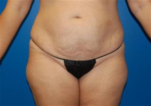 Tummy Tuck Before and After | SGK Plastic Surgery