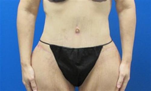 Tummy Tuck Before and After | SGK Plastic Surgery