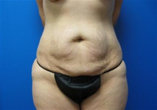 Tummy Tuck Before and After | SGK Plastic Surgery