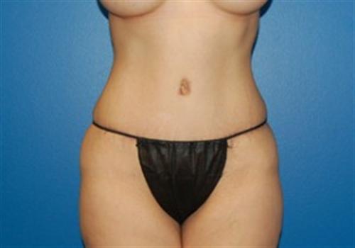 Tummy Tuck Before and After | SGK Plastic Surgery