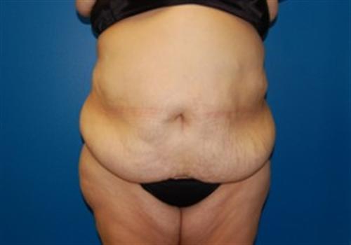 Tummy Tuck Before and After | SGK Plastic Surgery