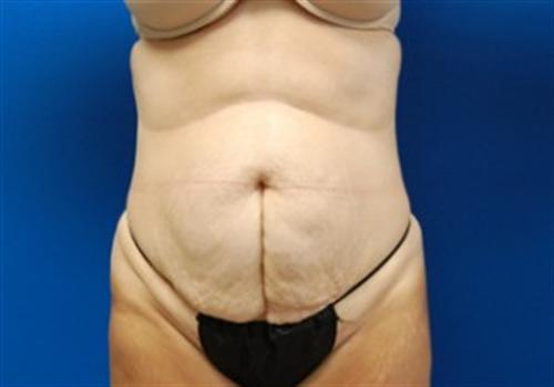 Tummy Tuck Before and After | SGK Plastic Surgery