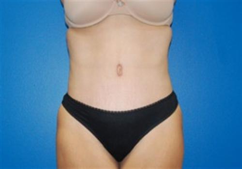 Tummy Tuck Before and After | SGK Plastic Surgery