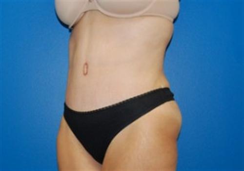 Tummy Tuck Before and After | SGK Plastic Surgery