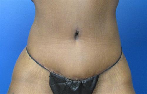 Tummy Tuck Before and After | SGK Plastic Surgery