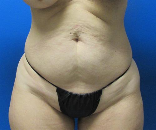 Tummy Tuck Before and After | SGK Plastic Surgery