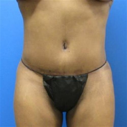 Tummy Tuck Before and After | SGK Plastic Surgery