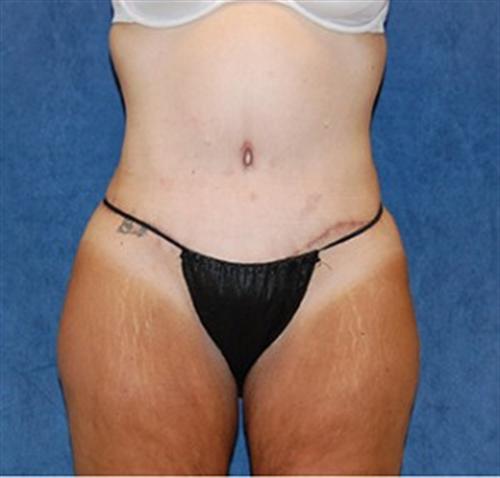 Tummy Tuck Before and After | SGK Plastic Surgery