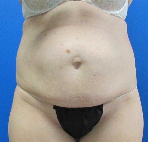 Tummy Tuck The Woodlands