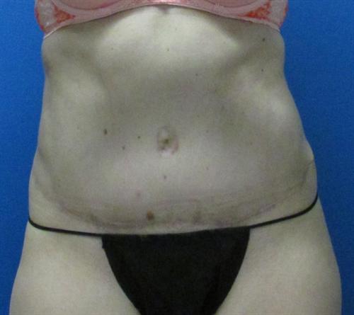 Tummy Tuck Before and After | SGK Plastic Surgery