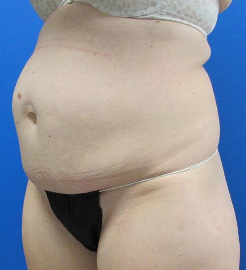 Tummy Tuck Before and After | SGK Plastic Surgery