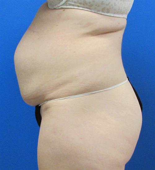 Tummy Tuck Before and After | SGK Plastic Surgery