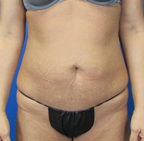 Tummy Tuck Before and After | SGK Plastic Surgery