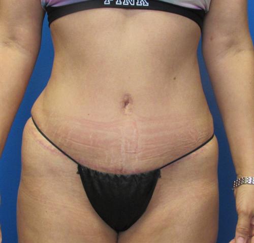 Tummy Tuck Before and After | SGK Plastic Surgery