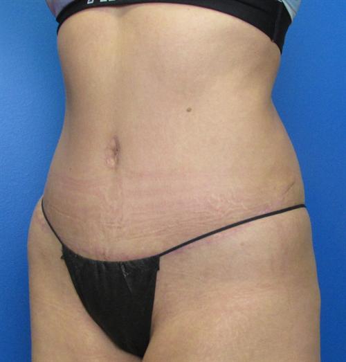 Tummy Tuck Before and After | SGK Plastic Surgery