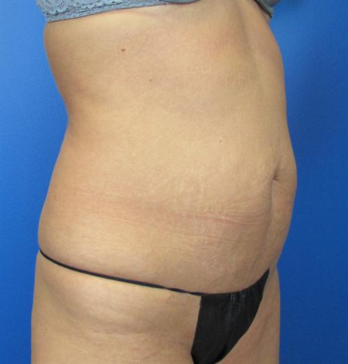 Tummy Tuck Before and After | SGK Plastic Surgery