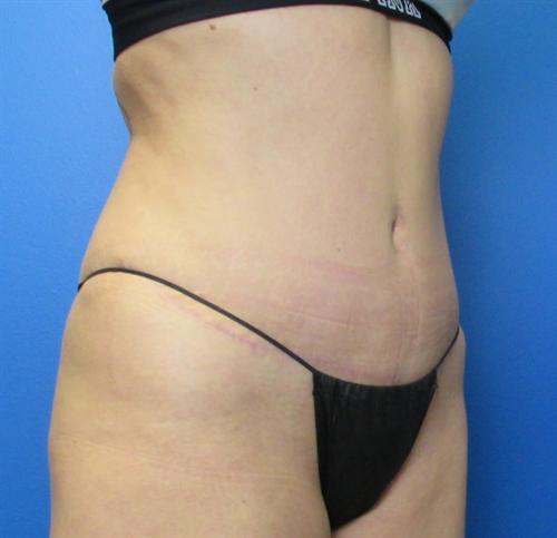 Tummy Tuck Before and After | SGK Plastic Surgery