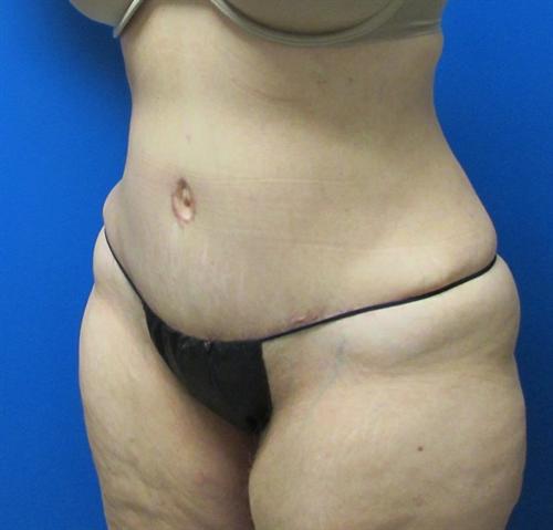 Tummy Tuck Before and After | SGK Plastic Surgery