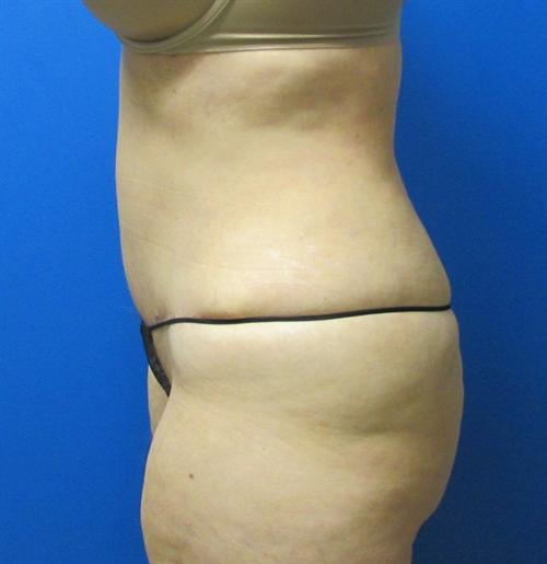 Tummy Tuck Before and After | SGK Plastic Surgery