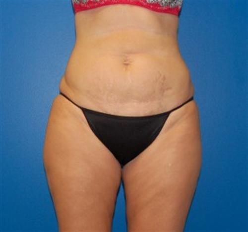 Tummy Tuck Before and After | SGK Plastic Surgery