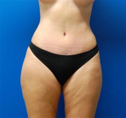 Tummy Tuck Before and After | SGK Plastic Surgery