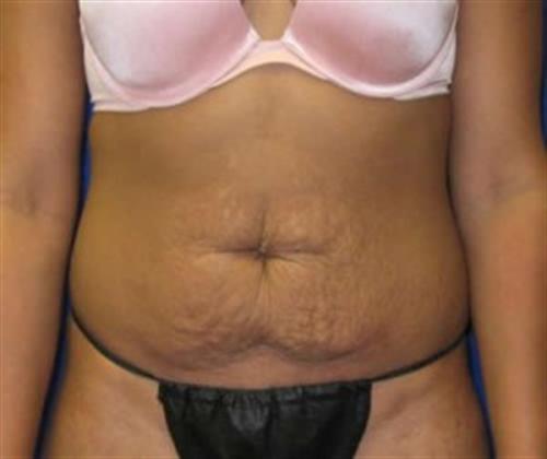 Tummy Tuck Before and After | SGK Plastic Surgery