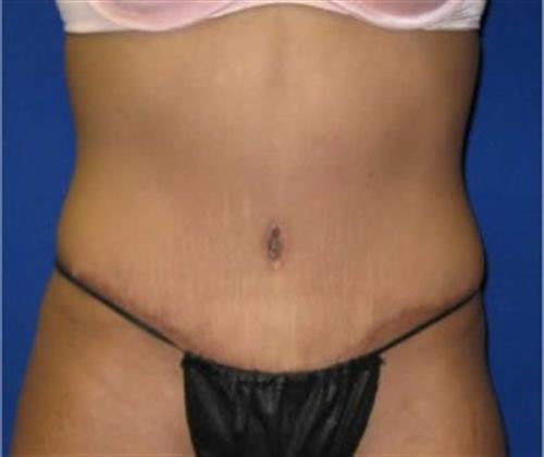 Tummy Tuck Before and After | SGK Plastic Surgery