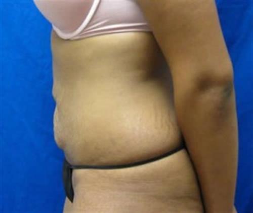 Tummy Tuck Before and After | SGK Plastic Surgery