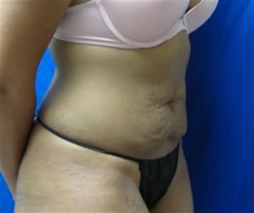 Tummy Tuck Before and After | SGK Plastic Surgery