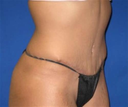 Tummy Tuck Before and After | SGK Plastic Surgery