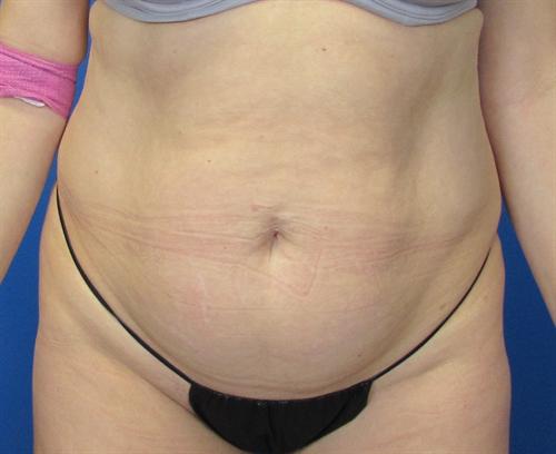 Tummy Tuck Before and After | SGK Plastic Surgery