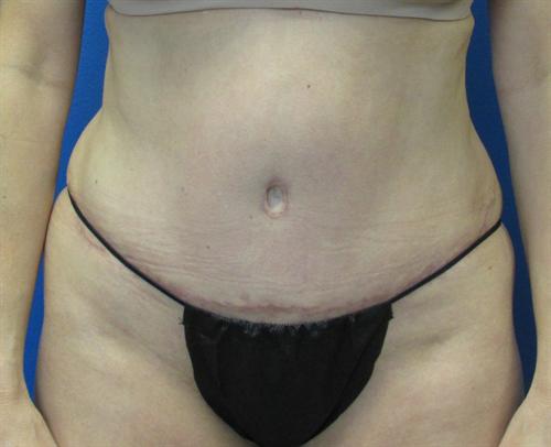 Tummy Tuck Before and After | SGK Plastic Surgery