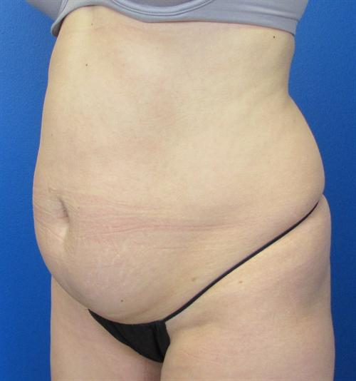 Tummy Tuck Before and After | SGK Plastic Surgery