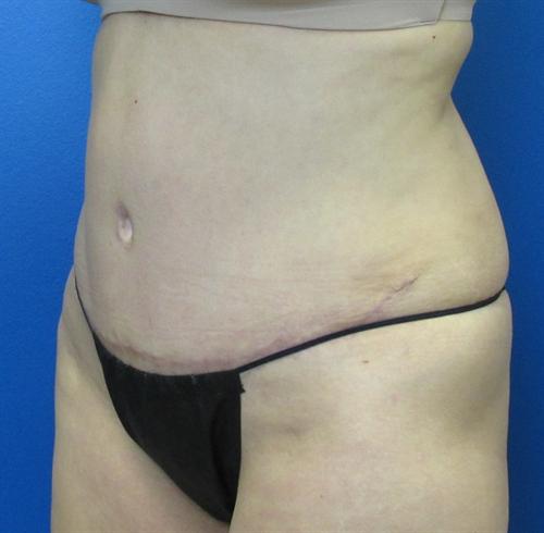 Tummy Tuck Before and After | SGK Plastic Surgery