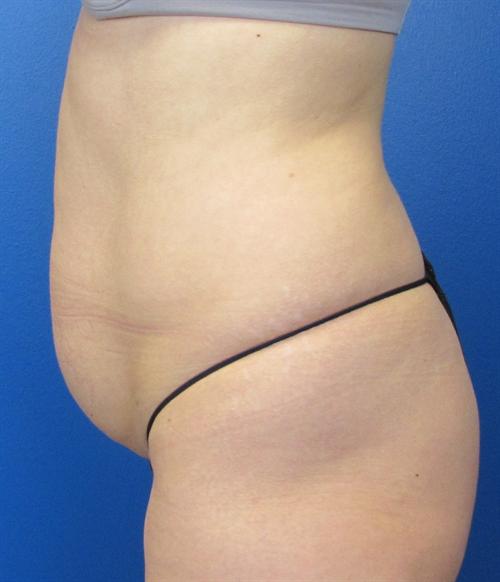 Tummy Tuck Before and After | SGK Plastic Surgery