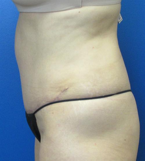 Tummy Tuck Before and After | SGK Plastic Surgery