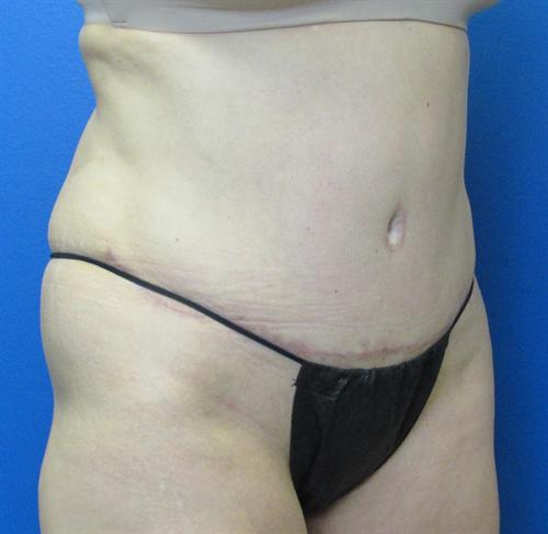 Tummy Tuck Before and After | SGK Plastic Surgery