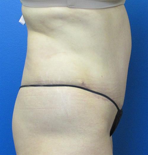 Tummy Tuck Before and After | SGK Plastic Surgery