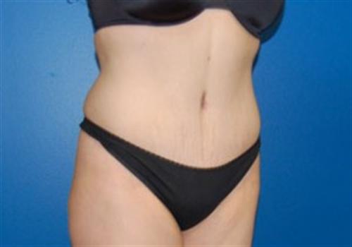 Tummy Tuck Before and After | SGK Plastic Surgery