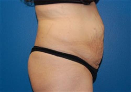 Tummy Tuck Before and After | SGK Plastic Surgery