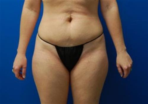 Tummy Tuck Before and After | SGK Plastic Surgery