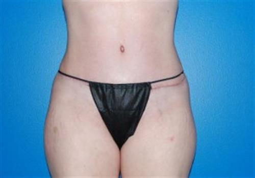 Tummy Tuck Before and After | SGK Plastic Surgery